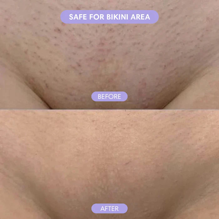 SmoothTrim™ – Precisie scheerapparaat met twee opzetstukken